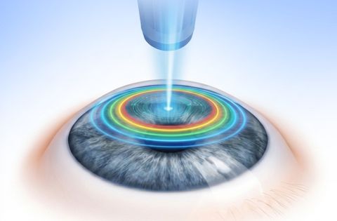 Contoura Vision LASIK