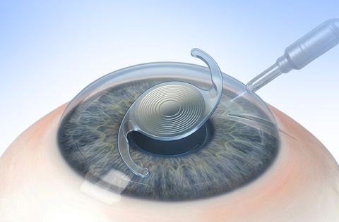 Refractive Cataract Surgery