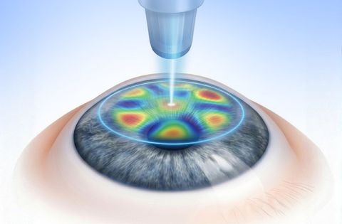 Wavefront Guided LASIK