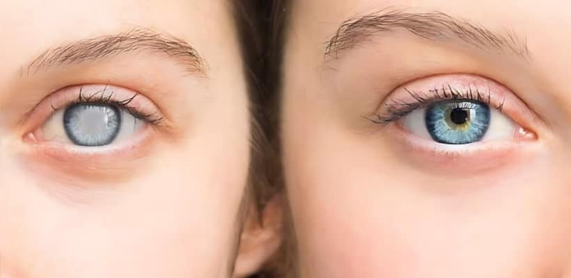 Types of Cataract Surgeries in India- Your Complete Guide