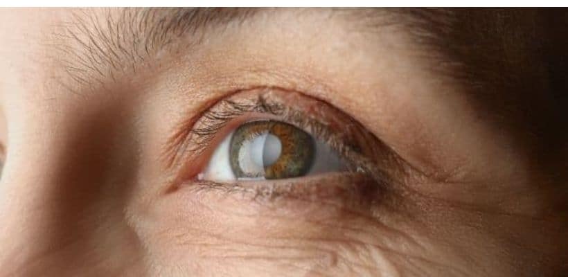 Cataract: Causes, Symptoms & Treatment