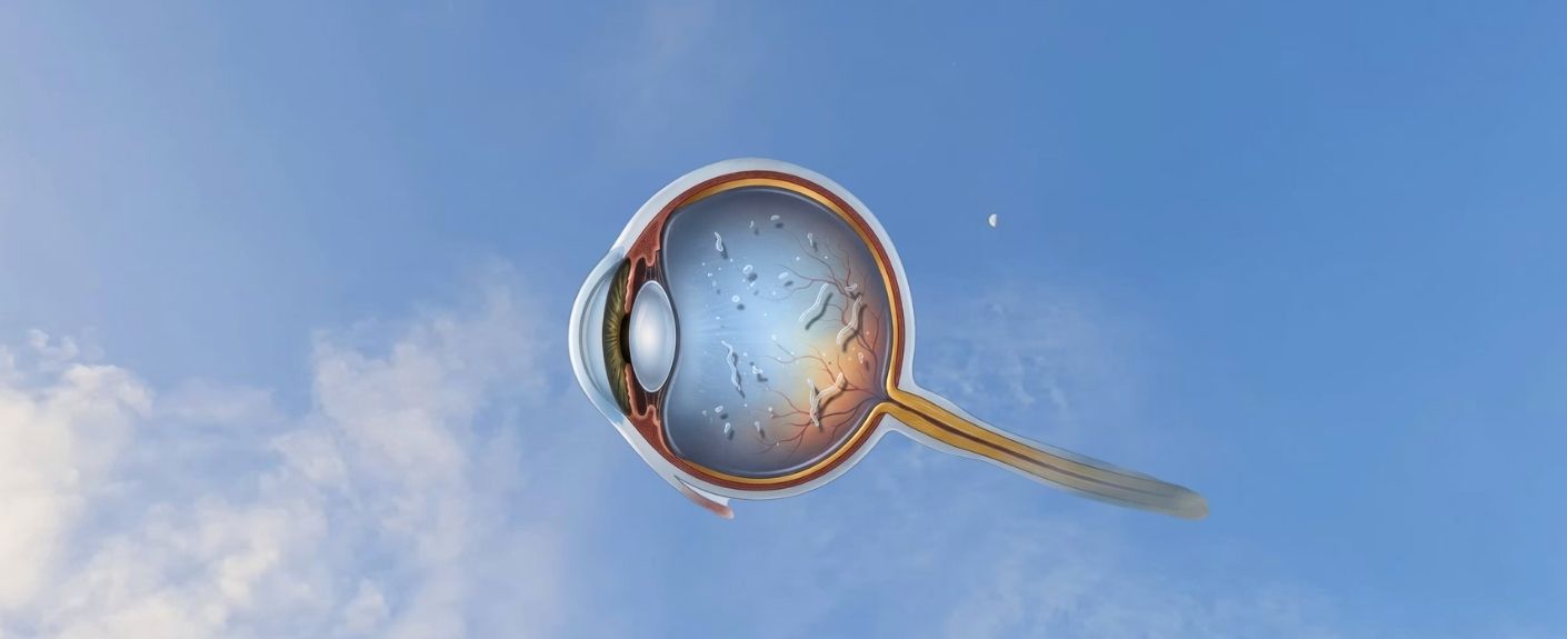 Eye Floaters: When Should You Worry?
