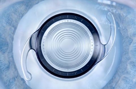 Trifocal IOL