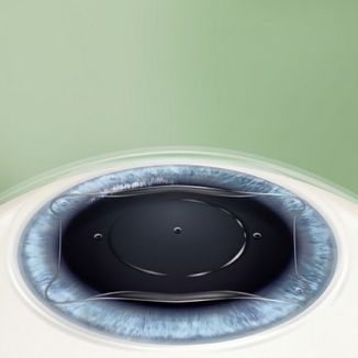 Implantable Collamer Lens (ICL)