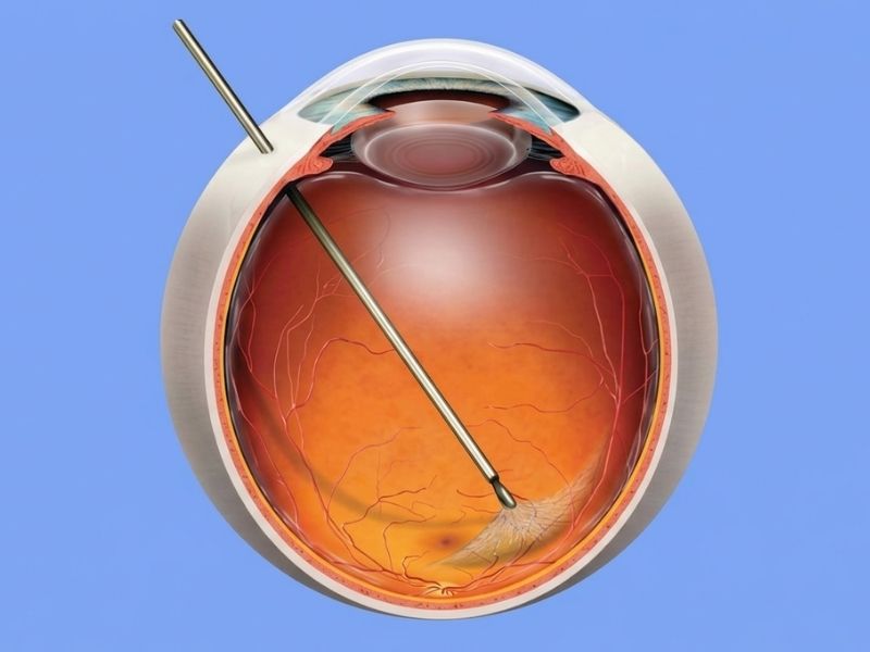 Macular Hole & Epiretinal Membrane