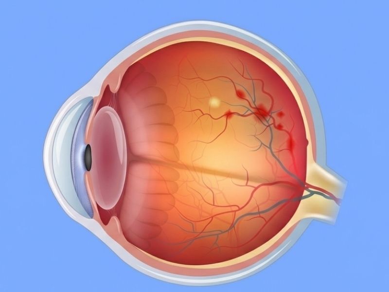 Retinal Vein Occlusion